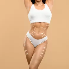 Karın Germe (Abdominoplasty) Nasıl Yapılır?